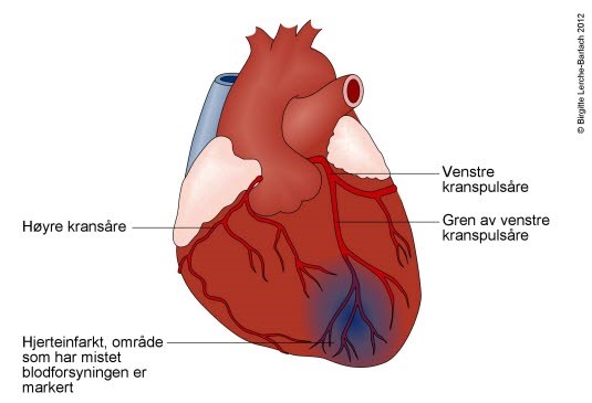 Hjerteinfarkt - Røde Kors Førstehjelp