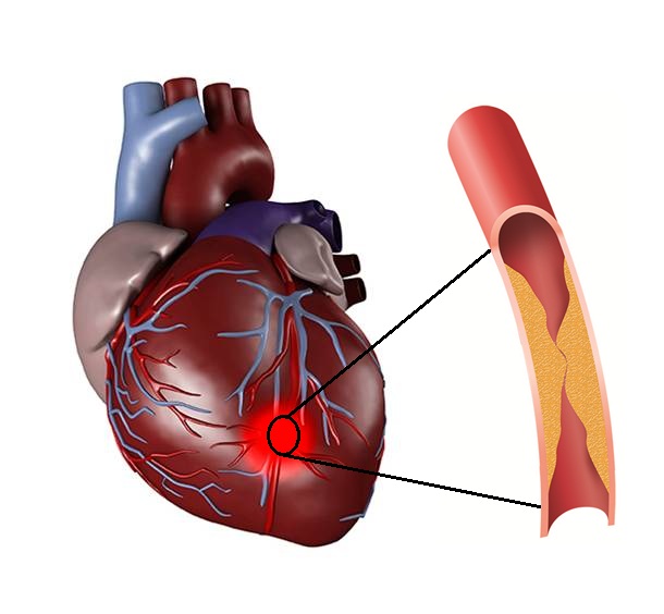 Illustrasjon som viser hva et hjerteinfarkt er